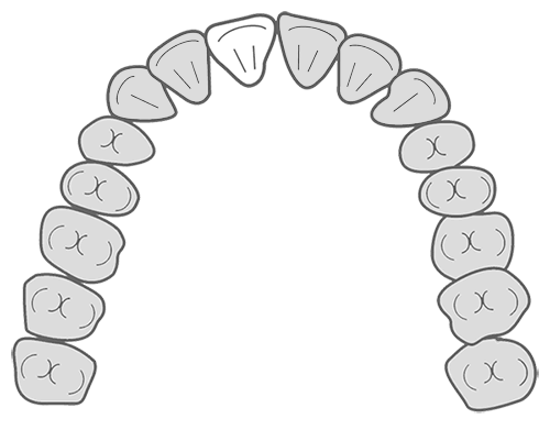 銀歯交換・審美的な虫歯治療イメージイラスト