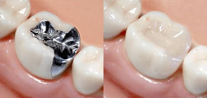 銀歯とセラミックの比較写真