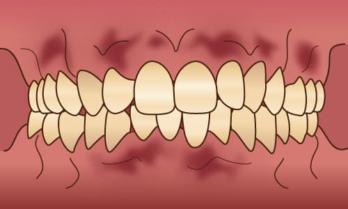 1. 歯肉の消毒・表面麻酔