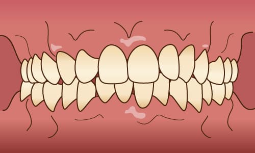 3. 歯肉の消毒・表面麻酔
